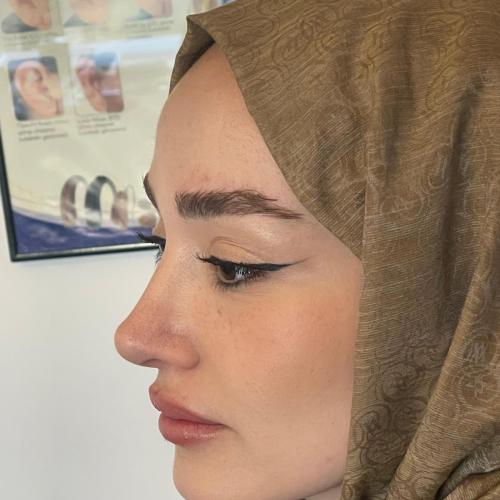 Ultrasound Rhinoplasty Before / After photo